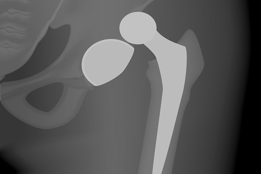 Hip Dislocation Following Surgery Avoid Hip Dislocation With These Tips