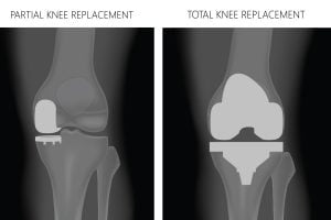 Partial Knee Replacement Vs. Total Knee Replacement